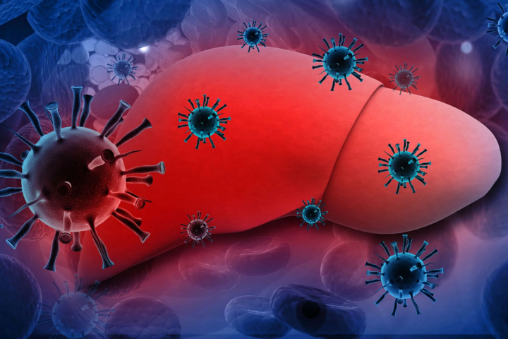 Hepatit A qaraciyərin virus xəstəliyidir