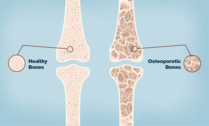 Çinli tədqiqatçılar osteoporoz üçün hidrogel müalicəsi hazırlayır