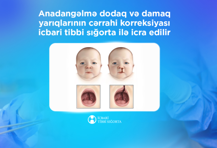 Anadangəlmə dodaq və damaq yarıqlarının cərrahi korreksiyası icbari tibbi sığorta ilə icra edilir