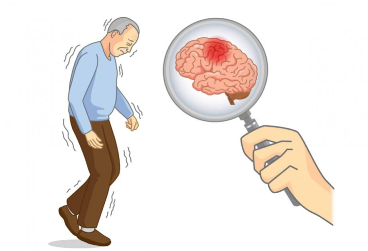 Parkinson xəstəliyi beyində deyil, böyrəklərdə başlaya bilər