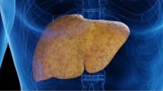 Yağlı qaraciyər xəstəliyini siqnal edə biləcək yüngül simptomlar